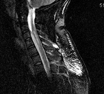 Cervical Epidural Abscess T2 MRI